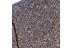 Immunohistochemical staining of human mantle cell lymphoma shows moderate to strong nuclear positivity in tumor cells.