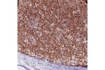 Immunohistochemical staining of human mantle cell lymphoma shows moderate to strong nuclear positivity in tumor cells.