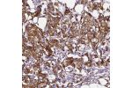 Immunohistochemical staining of human breast cancer shows strong cytoplasmic immunoreactivity in cancer cells.