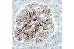 Immunohistochemical staining of human kidney (idiopathic membranous nephropathy) shows strong membranous positivity in cells in glomeruli.