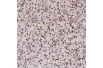 Immunohistochemical staining of human glioma shows strong nuclear positivity in tumor cells.