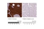 Immunohistochemical staining of human breast cancer shows moderate cytoplasmic immunoreactivity in tumour cells.