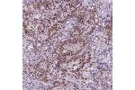 Immunohistochemical staining of human stomach cancer shows moderate nuclear positivity in tumor cells.