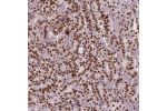 Immunohistochemical staining of human stomach cancer shows moderate to strong nuclear positivity in tumor cells.