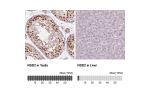 Immunohistochemical staining of human ventricular cancer shows strong nuclear immunoreactivity in tumor cells.