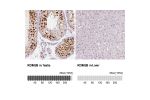 Immunohistochemical staining of human breast cancer shows strong nuclear immunoreactivity in tumor cells.