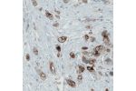 Immunohistochemical staining of human breast cancer shows membranous immunoreactivity in tumor cells.