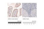 Immunohistochemical staining of human glioma shows moderate to strong nuclear positivity in tumor cells.