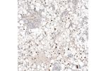 Immunohistochemical staining of human renal cancer shows moderate to strong nuclear positivity in tumor cells.