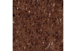 Immunohistochemical staining of human astrocytoma shows strong cytoplasmic positivity in tumor cells.