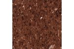 Immunohistochemical staining of human astrocytoma shows strong cytoplasmic positivity in tumor cells.