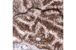 Immunohistochemical staining of human ovarian cancer (mucinous carcinoma) shows moderate membranous positivity in tumor cells.
