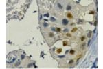 IHC staining of Human breast cancer tissue paraffin-embedded, diluted at 1:200