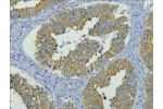 IHC staining of human colon cancer tissue, diluted at 1:200.