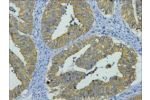 IHC staining of human colon cancer tissue, diluted at 1:200.