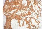 IHC staining of human gullet cancer tissue, diluted at 1:200.