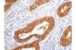 IHC staining of human colon cancer tissue, diluted at 1:200.