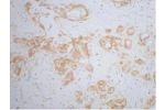 IHC staining of human breast cancer tissue, diluted at 1:200.