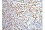 IHC staining of Human small cell carcinoma of lung tissue, diluted at 1:200.