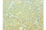 Immunohistochemical of paraffin-embedded human liver cancer using CSB-MA0014851A0m at dilution of 1:200