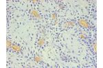 Immunohistochemical of paraffin-embedded Human breast cancer using CSB-MA0049471A0m (2E11-2B5) at dilution of 1:200.