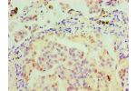 Immunohistochemical of paraffin-embedded Human lung cancer tissue using CSB-MA0150321A0m at dilution of 1:200.