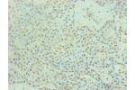 Immunohistochemical of paraffin-embedded human breast cancer using CSB-MA0187241A0m at dilution of 1:200