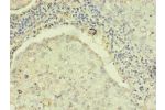 Immunohistochemistry of paraffin-embedded human lung cancer using CSB-MA0205181A0m in 30ug/ml dilute concentrations.