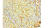 Immunohistochemical of paraffin-embedded human cervical cancer  using CSB-MA0206411A0m at dilution of 1:200