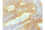 Immunohistochemical of paraffin-embedded human colon cancer using CSB-MA0234331A0m at dilution of 1:200