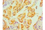 Immunohistochemical of paraffin-embedded Human lung cancer tissue using CSB-MA0240771A0m at dilution of 1:200.