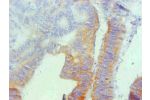 Immunohistochemical of paraffin-embedded human colon cancer using CSB-MA069021A0m at dilution of 1:200