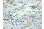 Immunohistochemical of paraffin-embedded human breast cancer tissue using CSB-MA077601A0m at dilution of 1:200