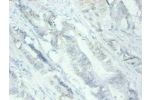 Immunohistochemical of paraffin-embedded human Colon cancer tissues using CSB-MA079741A0m at dilution of 1:200