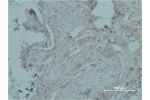 Immunohistochemical analysis of paraffin-embedded human breast caricnoma using PR Monoclonal Antibody.