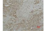 Immunohistochemical analysis of paraffin-embedded human Breast caricnoma using CYCS Monoclonal Antibody.