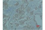 Immunohistochemical analysis of paraffin-embedded Human Lung caricnoma using Catenin-