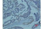 Immunohistochemical analysis of paraffin-embedded human colon caricnoma using Survivin Monoclonal Antibody.