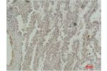Immunohistochemical analysis of paraffin-embedded Human Lung Carcinoma using CREB-1 Monoclonal Antibody.
