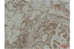 Immunohistochemical analysis of paraffin-embedded Human Breast Carcinoma using Pan Methylated Lysine Monoclonal Antibody.