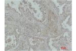 Immunohistochemical analysis of paraffin-embedded Human Lung Carcinoma using MICU1 Monoclonal Antibody.