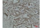 Immunohistochemical analysis of paraffin-embedded Human Breast Carcinoma using Acetyl Lysine Monoclonal Antibody.