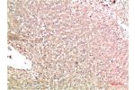 Immunohistochemical analysis of paraffin-embedded Human Liver Carcinoma Tissue using TTR Mouse mAb diluted at 1:200.