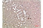 Immunohistochemical analysis of paraffin-embedded Human Liver Carcinoma Tissue using TTR Mouse mAb diluted at 1:200.