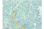 Immunohistochemical of paraffin-embedded human gastric cancer tissue using  CSB-MA112991A0m at dilution of 1:200