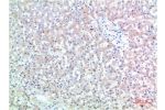 Immunohistochemical analysis of paraffin-embedded Human Liver Carcinoma Tissue using TTR Mouse mAb diluted at 1:200.