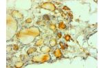 Immunohistochemical of paraffin-embedded human thyroid tissues using CSB-MA1213441A0m at dilution of 1:200