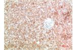 Immunohistochemical analysis of paraffin-embedded Human Liver Carcinoma Tissue using TTR Mouse mAb diluted at 1:200.