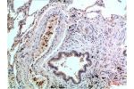 Immunohistochemical analysis of paraffin-embedded Human Lung Carcinoma Tissue using P38  Mouse mAb diluted at 1:200.