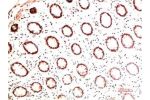 Immunohistochemical analysis of paraffin-embedded Human Colon Carcinoma Tissue using Collagen I  Mouse mAb diluted at 1:200.